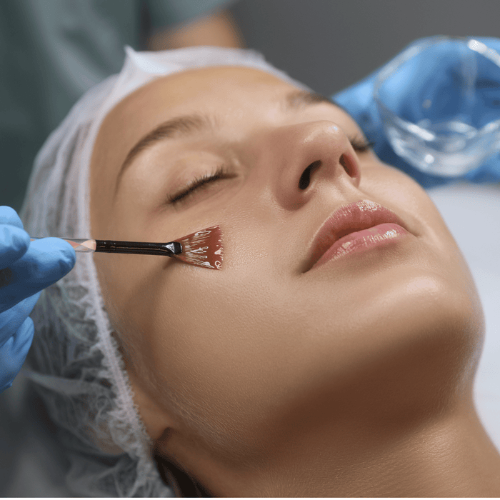 Add-On Chemical Peel