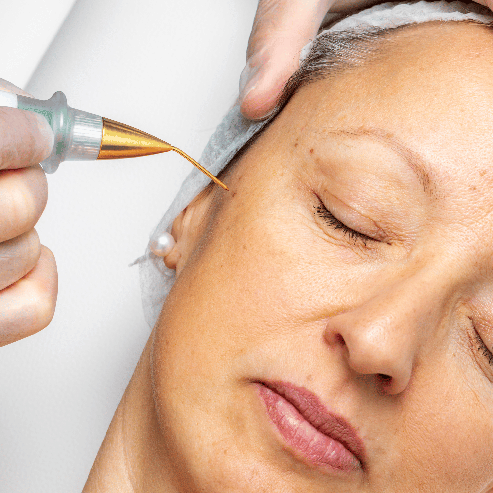 SKIN TAG REMOVAL TREATMENT