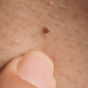 SKIN TAG REMOVAL TREATMENT