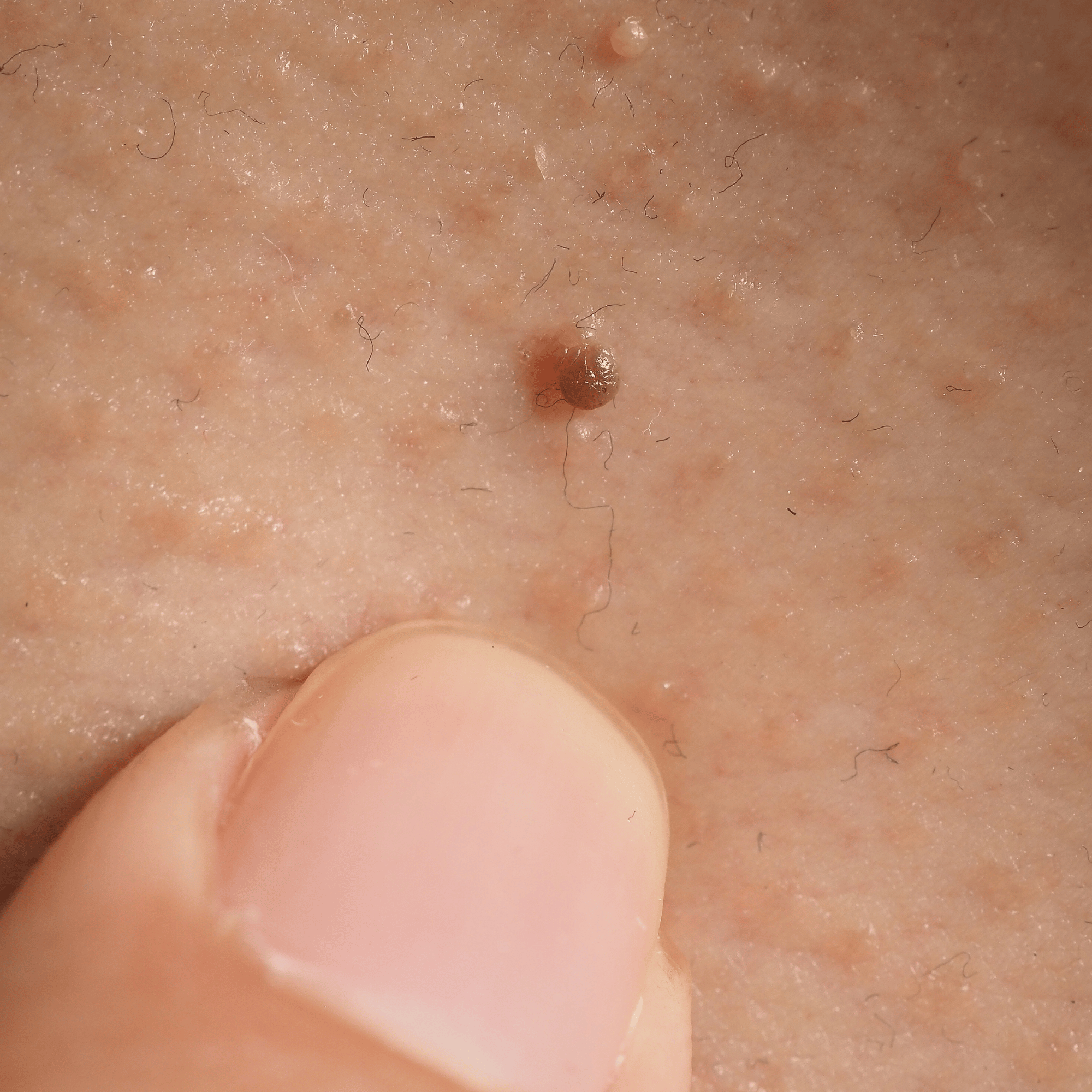 SKIN TAG REMOVAL TREATMENT