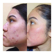 HERBAL NATURAL FACE TREATMENT