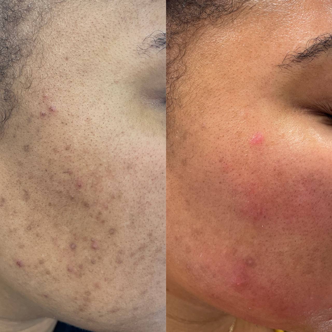 HERBAL NATURAL FACE TREATMENT