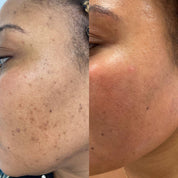 HERBAL NATURAL FACE TREATMENT