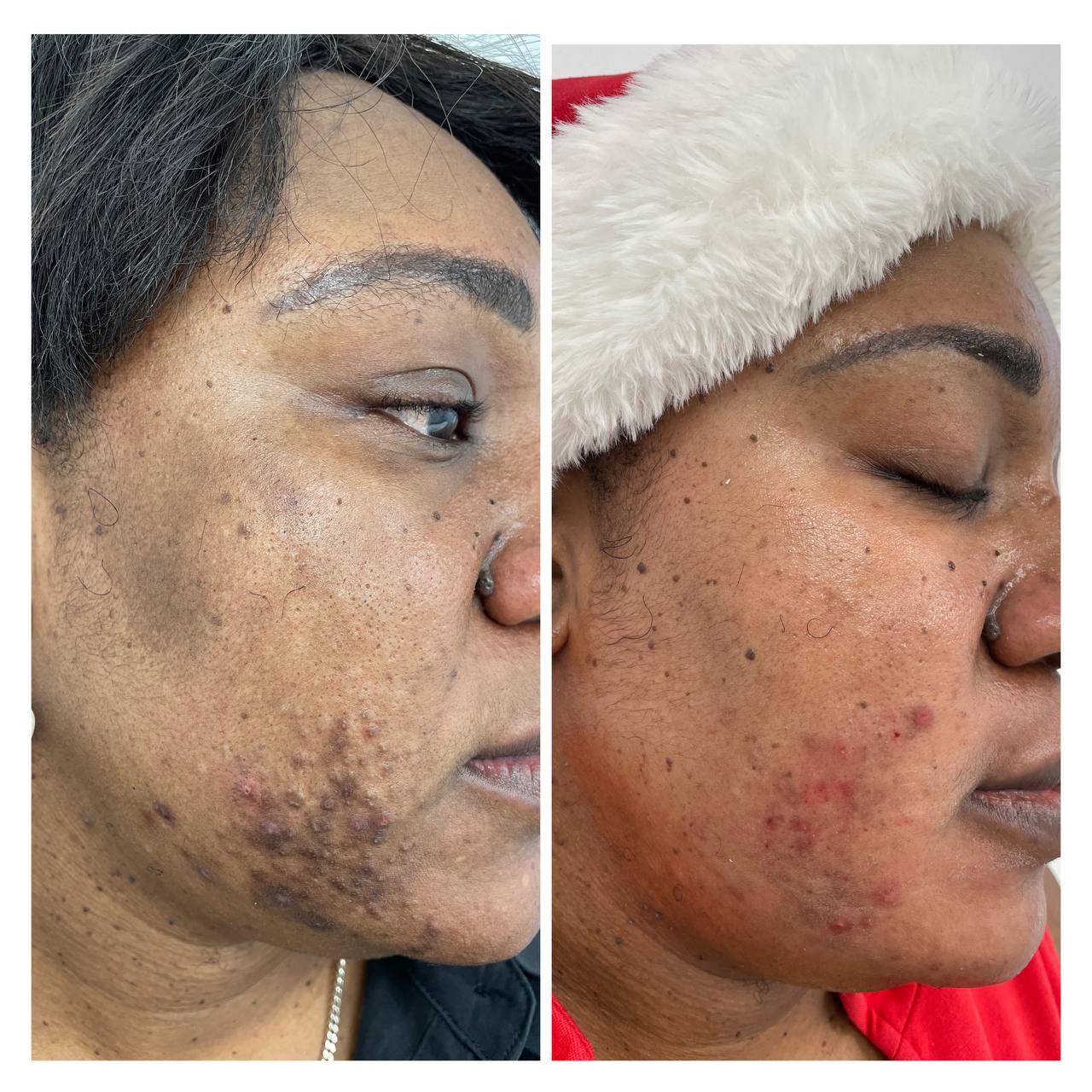 HERBAL NATURAL FACE TREATMENT