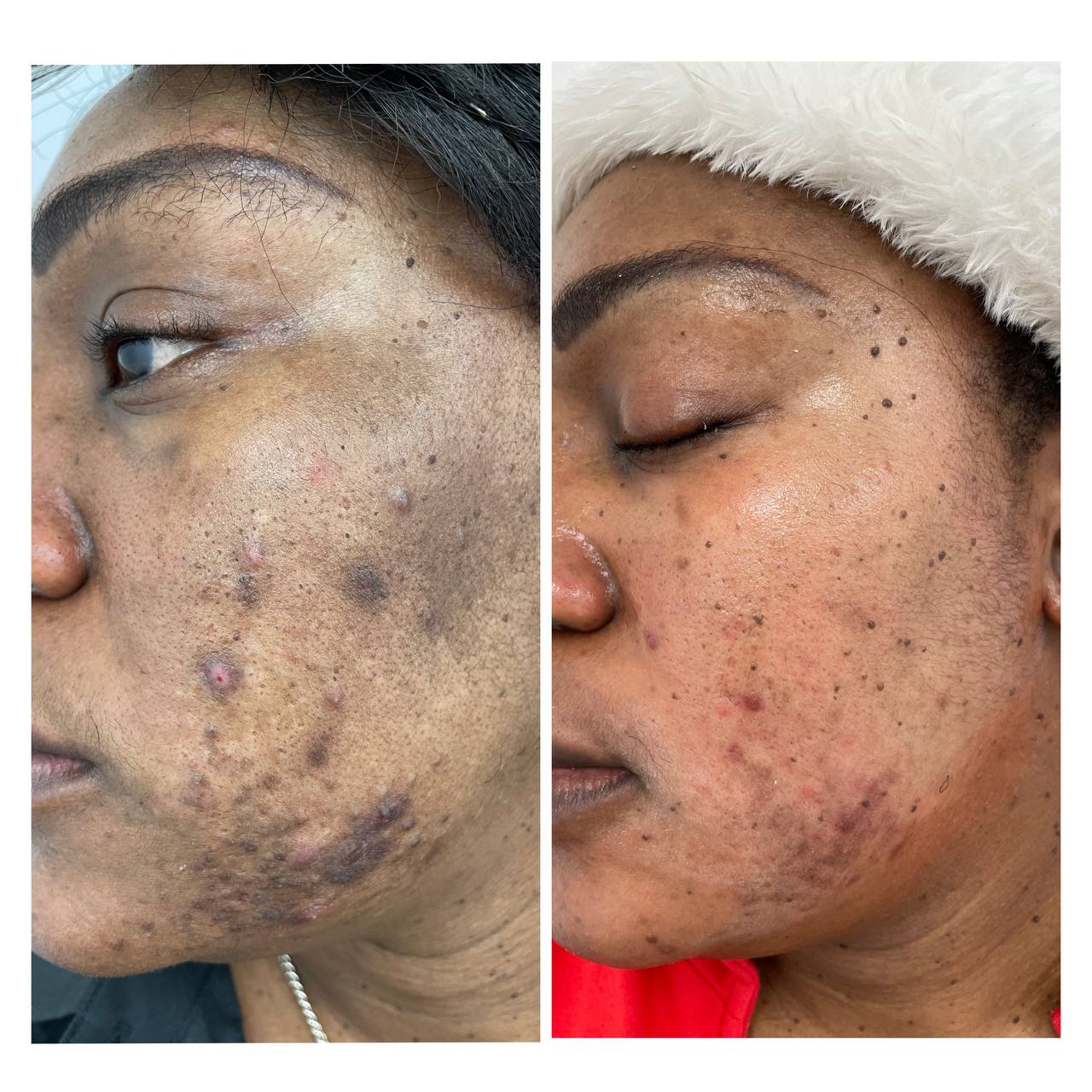 HERBAL NATURAL FACE TREATMENT